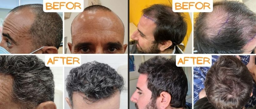 השתלת שיער איילת גייר